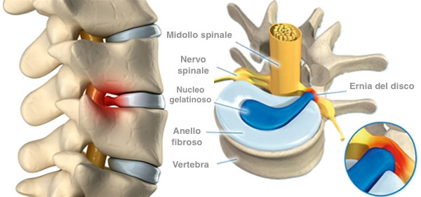 Ernia del disco è una patologia della colonna vertebrale, che provoca comparsa di dolore.