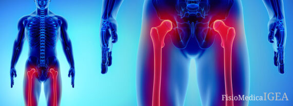 Frattura del Femore: Cause, Diagnosi e Trattamenti. FisioMedica IGEA