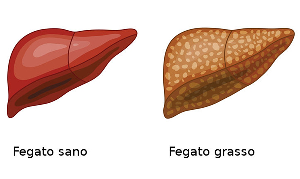 Steatosi Epatica: Tutto Ciò Che Devi Sapere