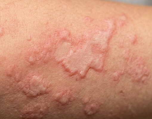 Orticaria: sintomi, cause e cura.