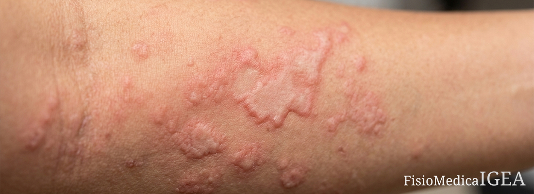 Orticaria: sintomi, cause e cura.